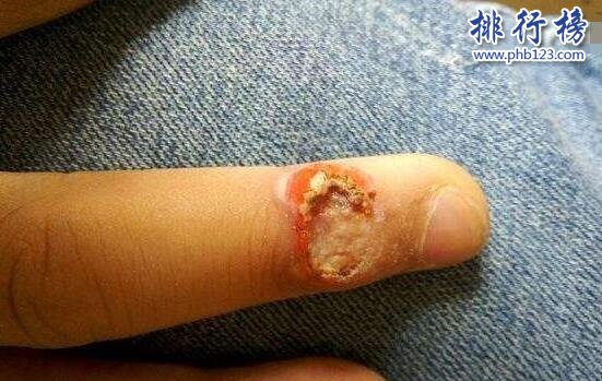 空手指是什麼病能治好嗎 空手指圖片是真的嗎(令人全身發麻)