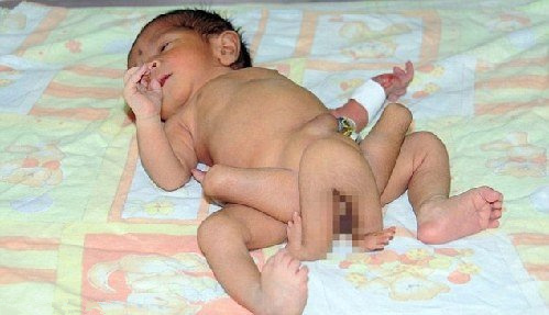 寄生雙胞胎 六腿嬰兒