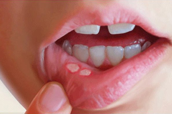 口腔潰瘍圖片，引起口腔潰瘍的原因有哪些