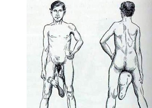 世界十大怪胎 擁有兩個陰莖的男人