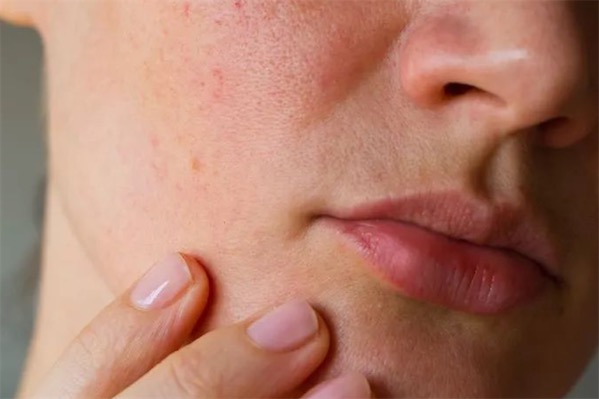 皮膚乾燥過敏該怎么辦