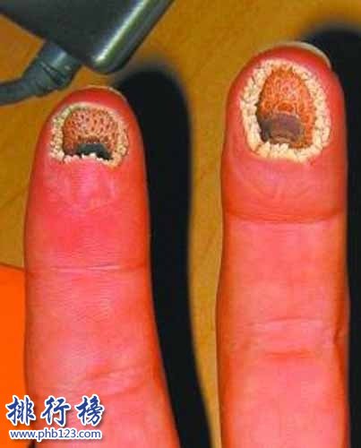 空手指是什麼病能治好嗎 空手指圖片是真的嗎(令人全身發麻)