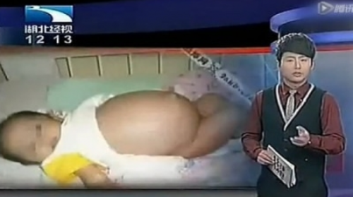 男嬰肚裡藏“胎兒”